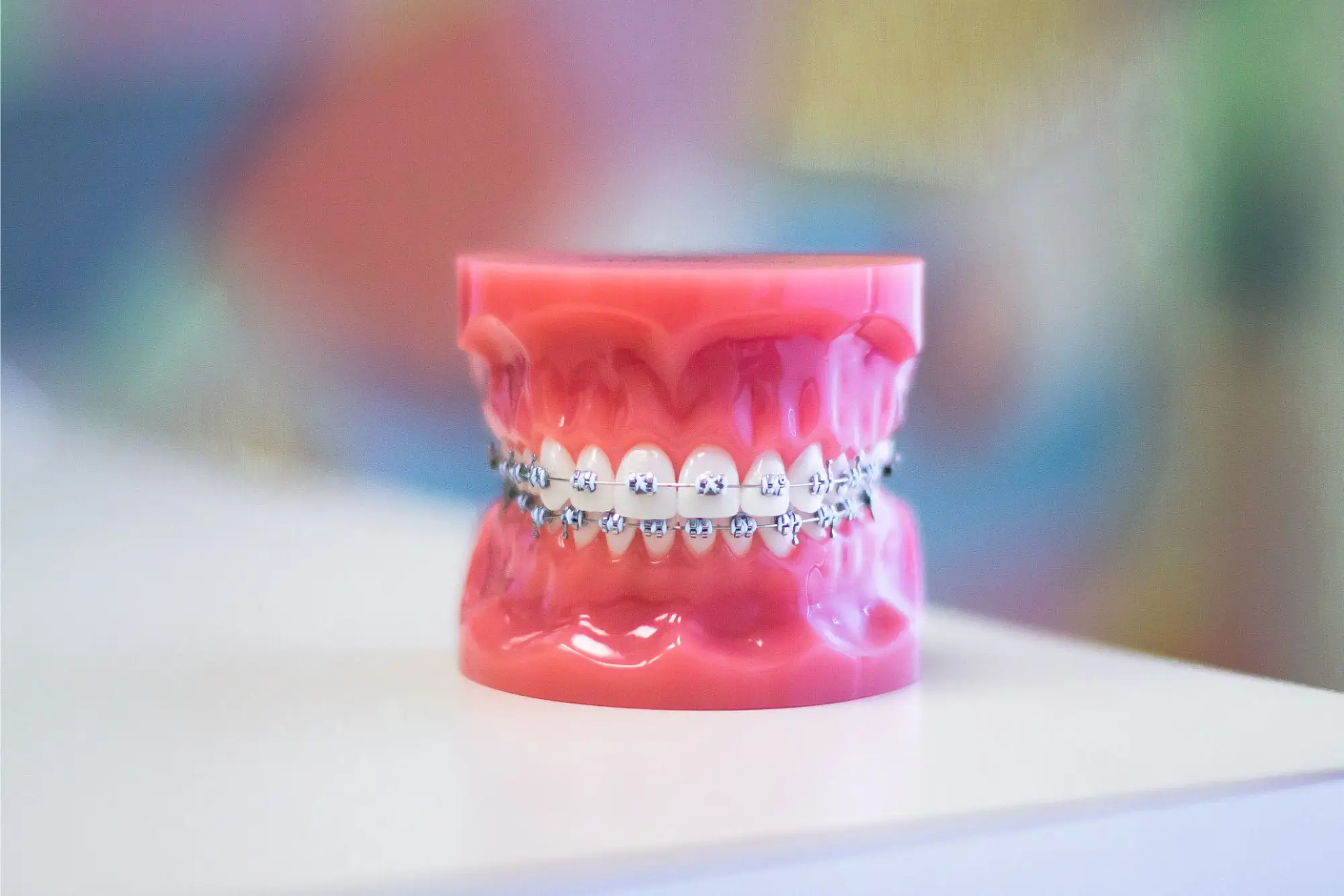 dental model showing metal braces on the upper and lower teeth